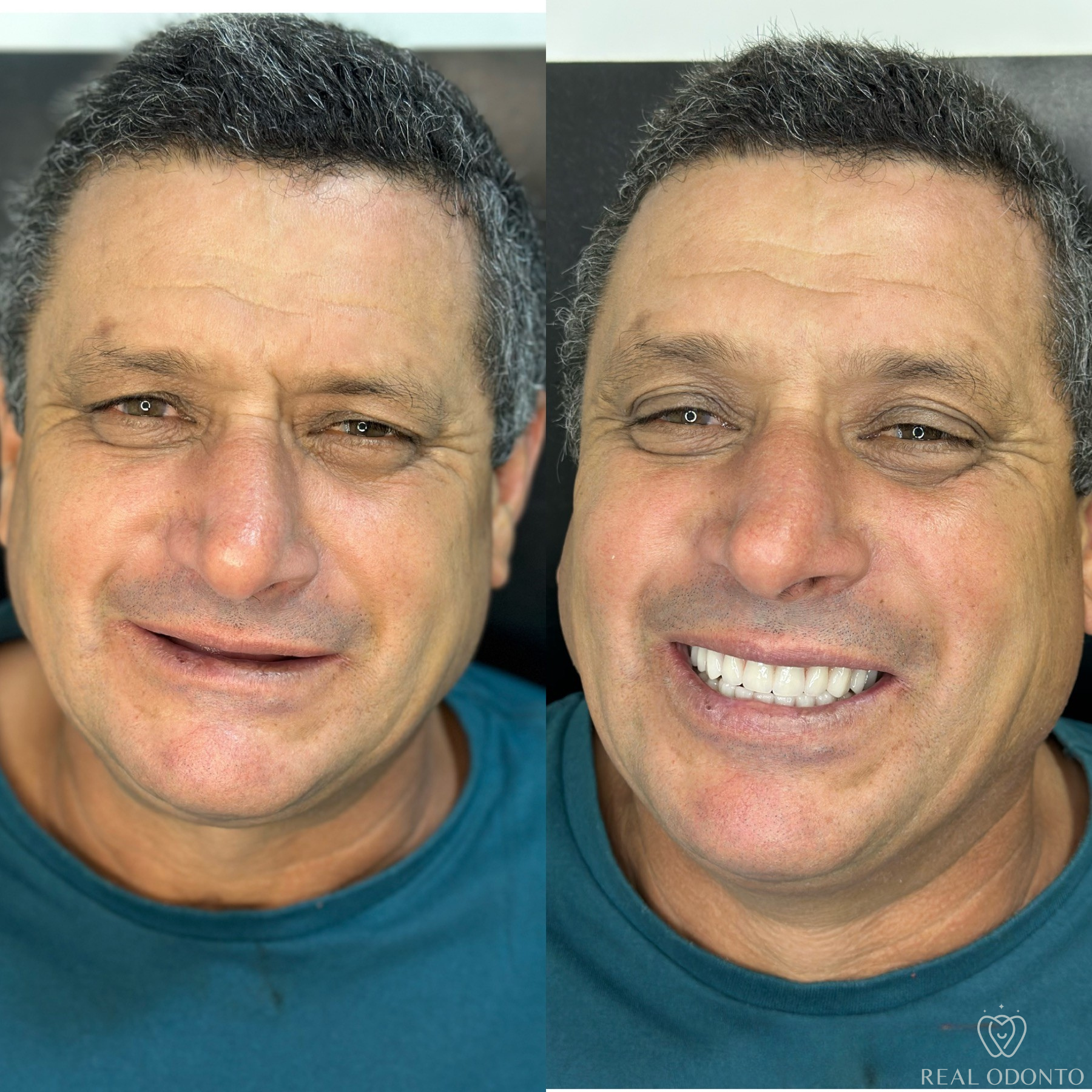 Dentadura fixa (prótese protocolo) antes e depois - Real Odonto