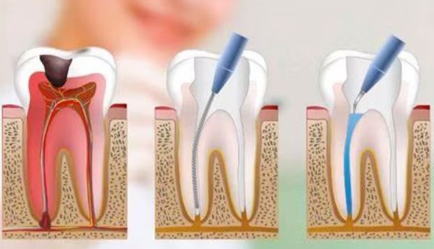 Endodontia (canal) em Guaxupé - Real Odonto