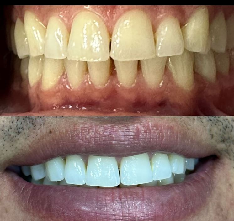 Resultado de clareamento dental - Real Odonto