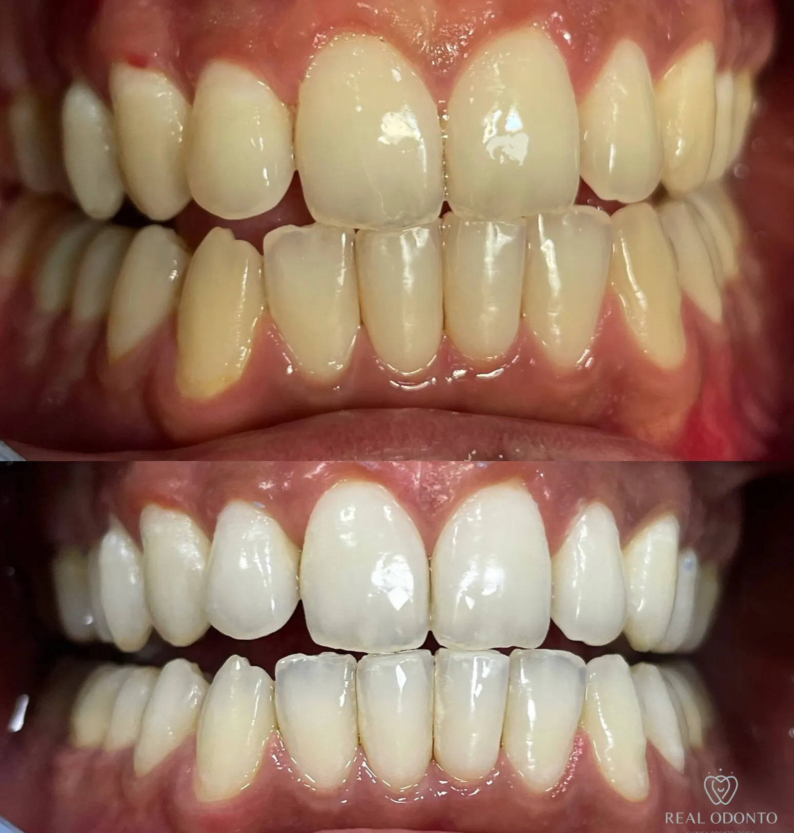 Clareamento dental na Real Odonto