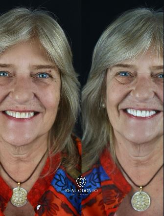 Facetas em resina - Real Odonto