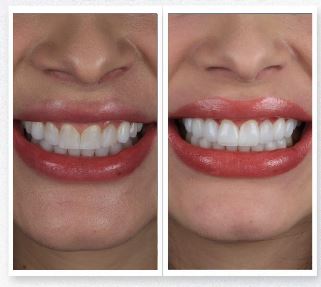 Facetas em porcelana - Real Odonto