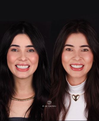 Facetas em porcelana - Real Odonto