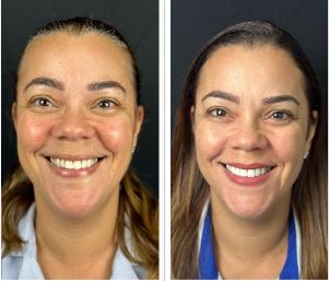 Facetas em porcelana - Real Odonto