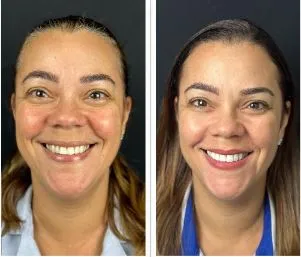 Facetas em porcelana - Real Odonto