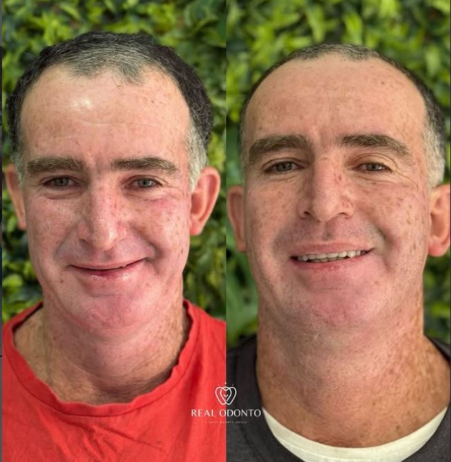 Resultado de prótese protocolo - Real Odonto