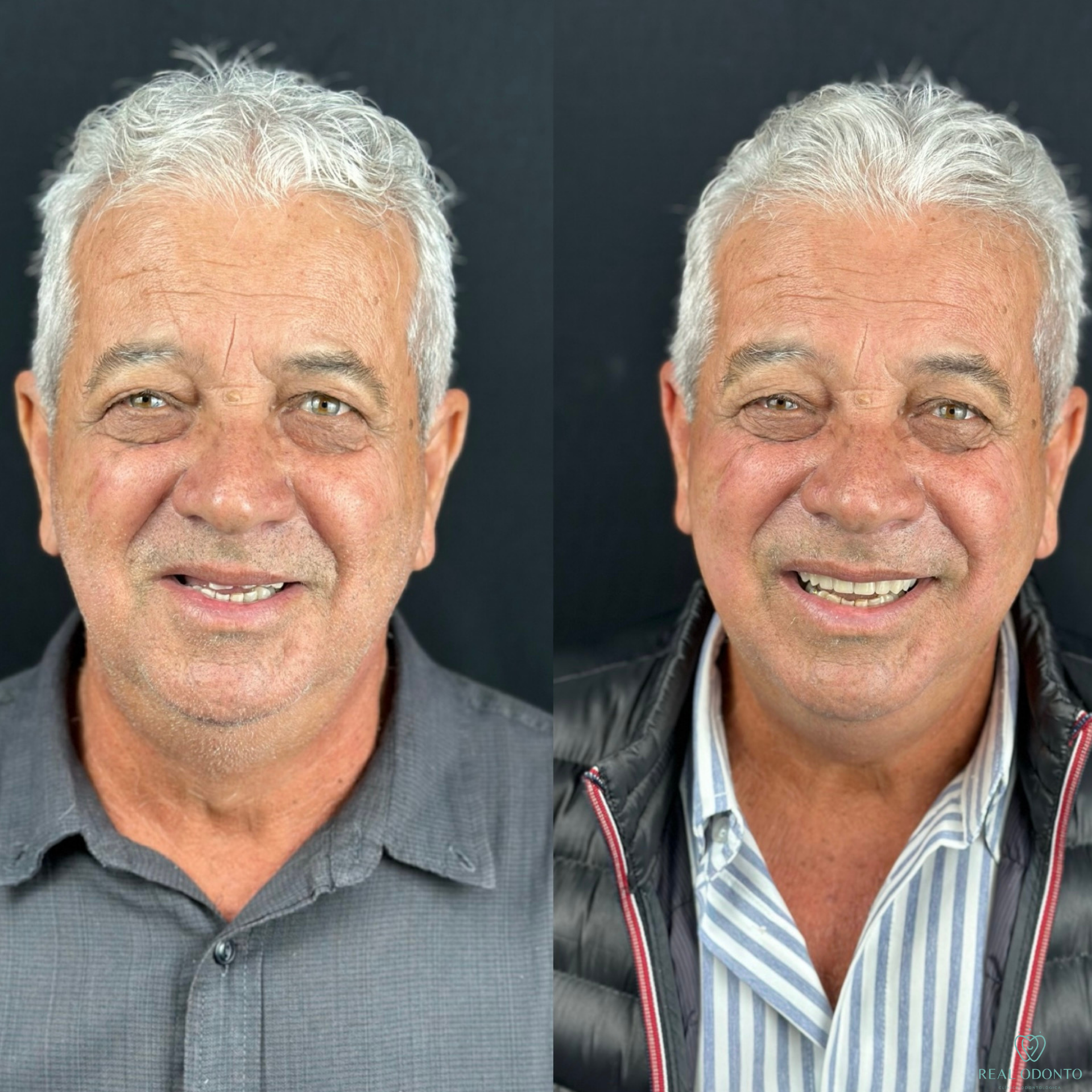 Prótese protocolo antes e depois - Real Odonto