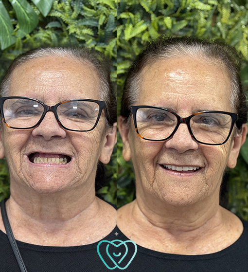 Dentadura fixa sobre implantes - Real Odonto