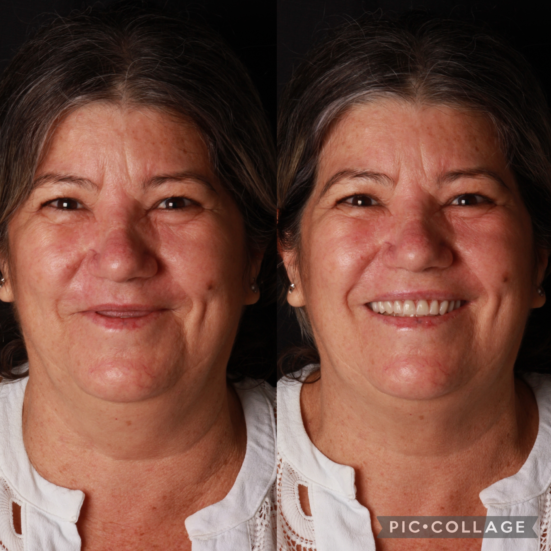 Dentadura fixa sobre implantes - Real Odonto