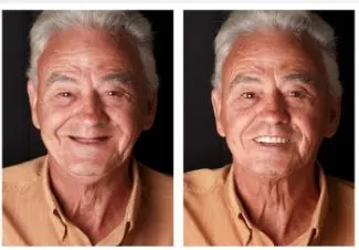 Dente fixo com prótese protocolo - Real Odonto