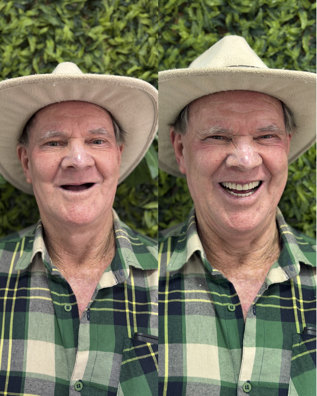Dente fixo com prótese protocolo - Real Odonto