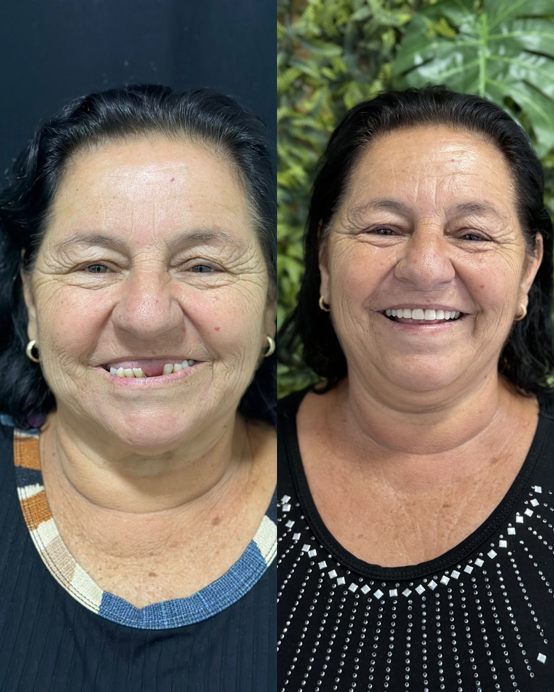Dente fixo com prótese protocolo - Real Odonto
