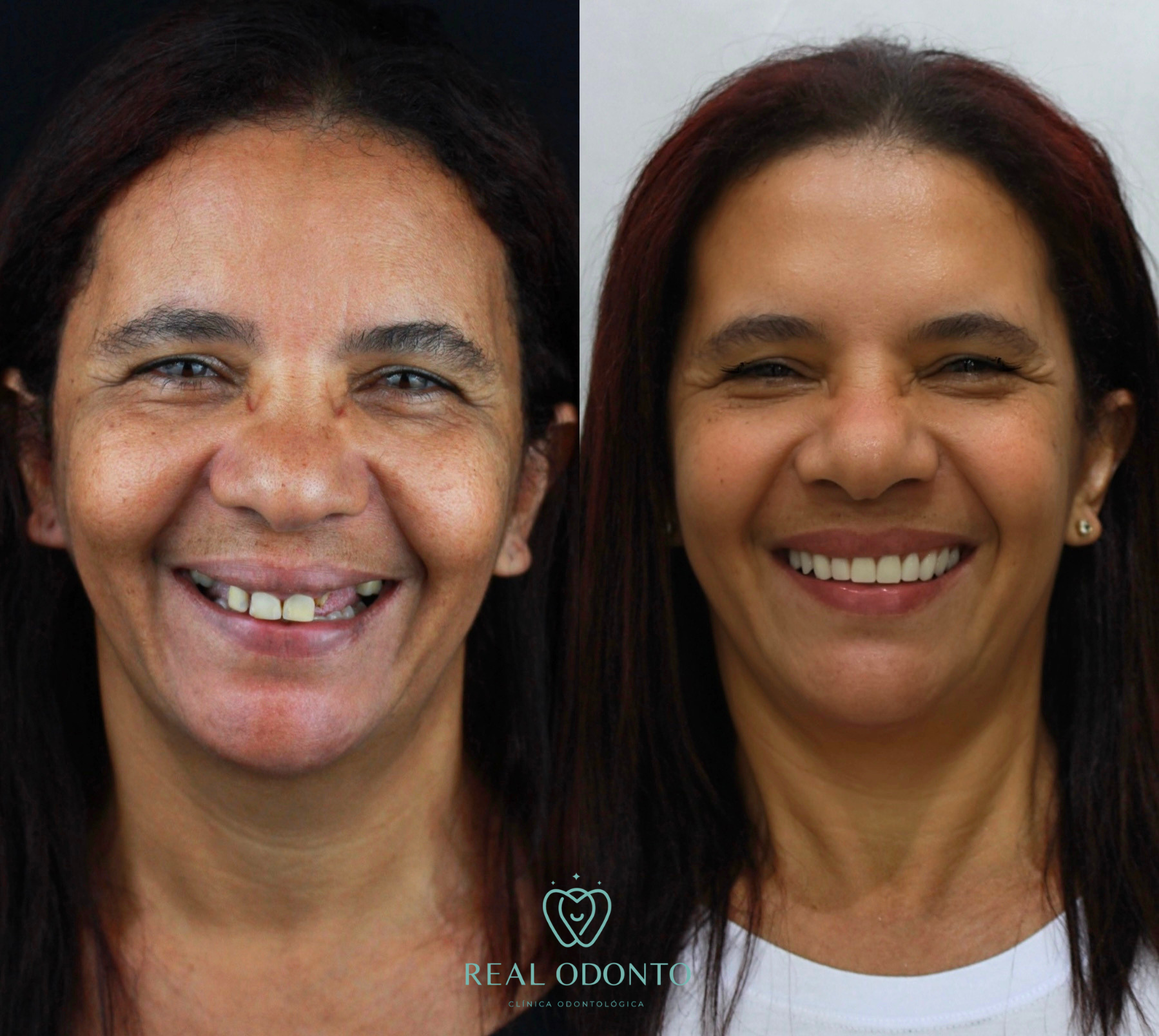 Dentadura fixa sobre implantes - Real Odonto