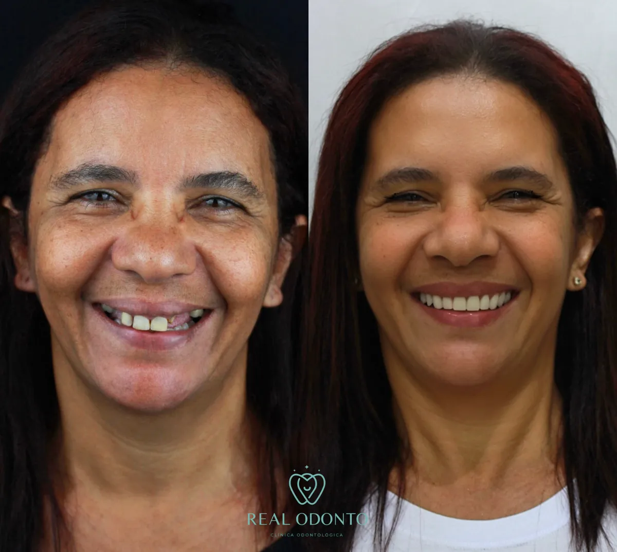 Dentadura fixa sobre implantes - Real Odonto